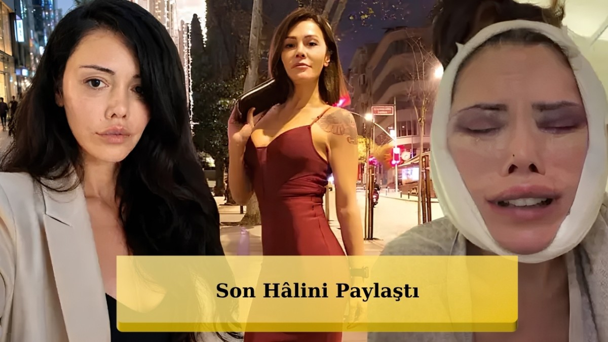 Yüz Nakli Yaptıran Eski Survivor Yarışmacısı Didem Ceran Son Hâlini Paylaştı